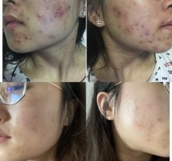 点击看大图 -苗方清颜痘肌研究所