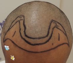 -大麦微针植发全国连锁