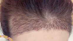 -大麦微针植发丨全国连锁