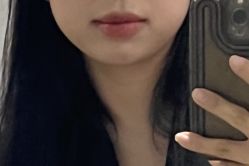 点击看大图 体验前-重庆军科整形美容医院