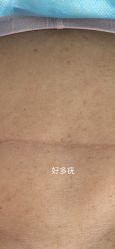 -美丽人生祛斑扁平疣汗管瘤中心