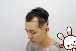 -大麦微针植发丨全国连锁