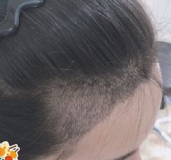 -大麦微针植发丨全国连锁