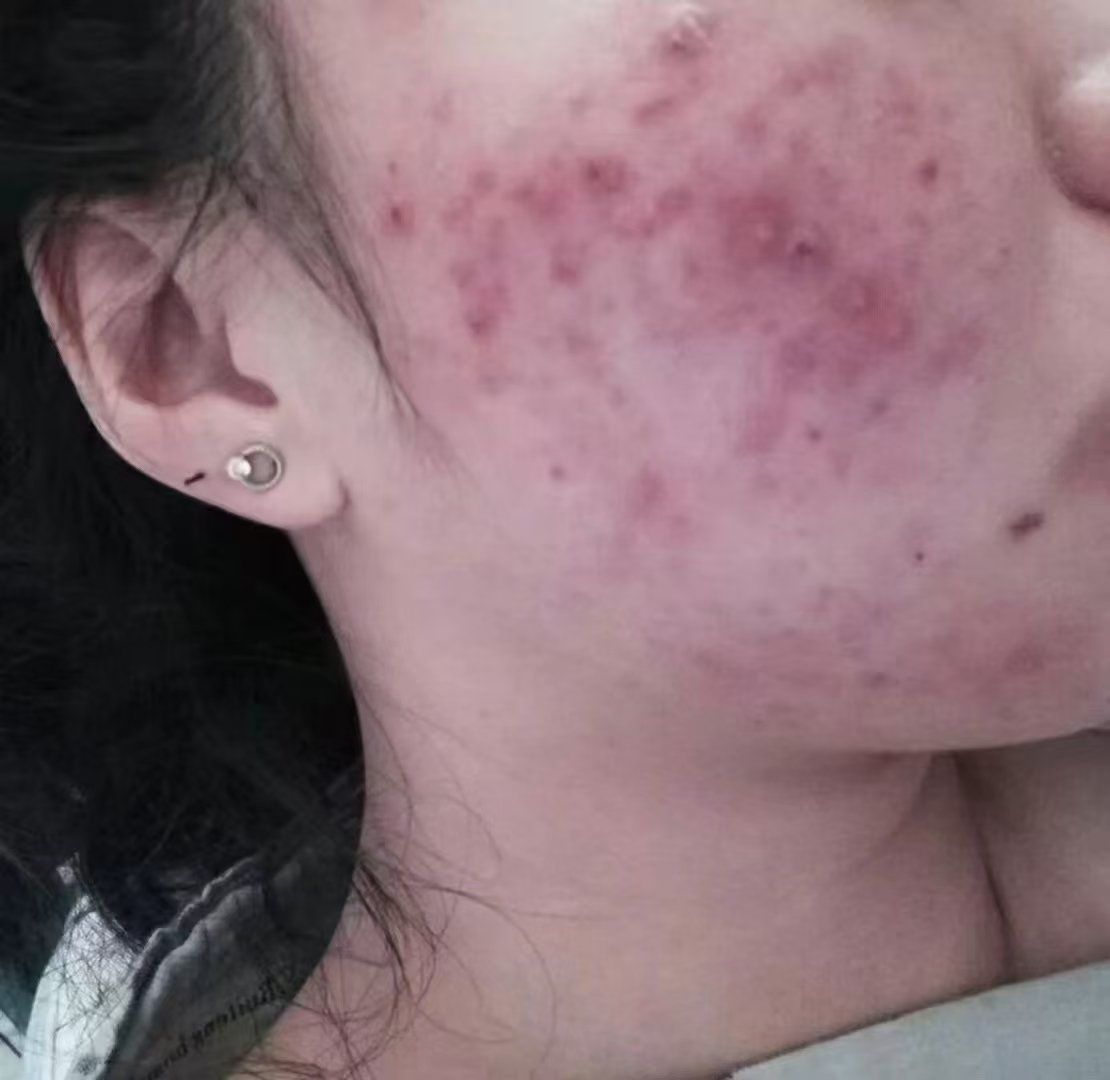 痘痘不请自来怎么办