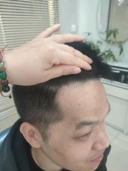 点击看大图 -大麦微针植发丨全国连锁