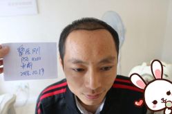 点击看大图 -大麦微针植发丨全国连锁