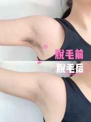 -小梨·OndaPro·专业脱毛连锁机构