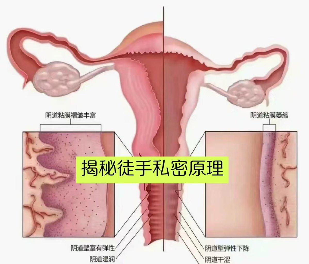 阴壁增生肉芽图片