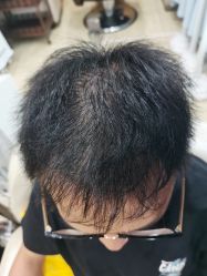 -大麦微针植发全国连锁