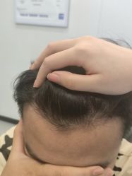体验后-大麦微针植发全国连锁