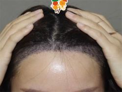 -大麦微针植发全国连锁