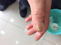 点击看大图 -德哥灰指甲脚气甲沟炎跖疣护理