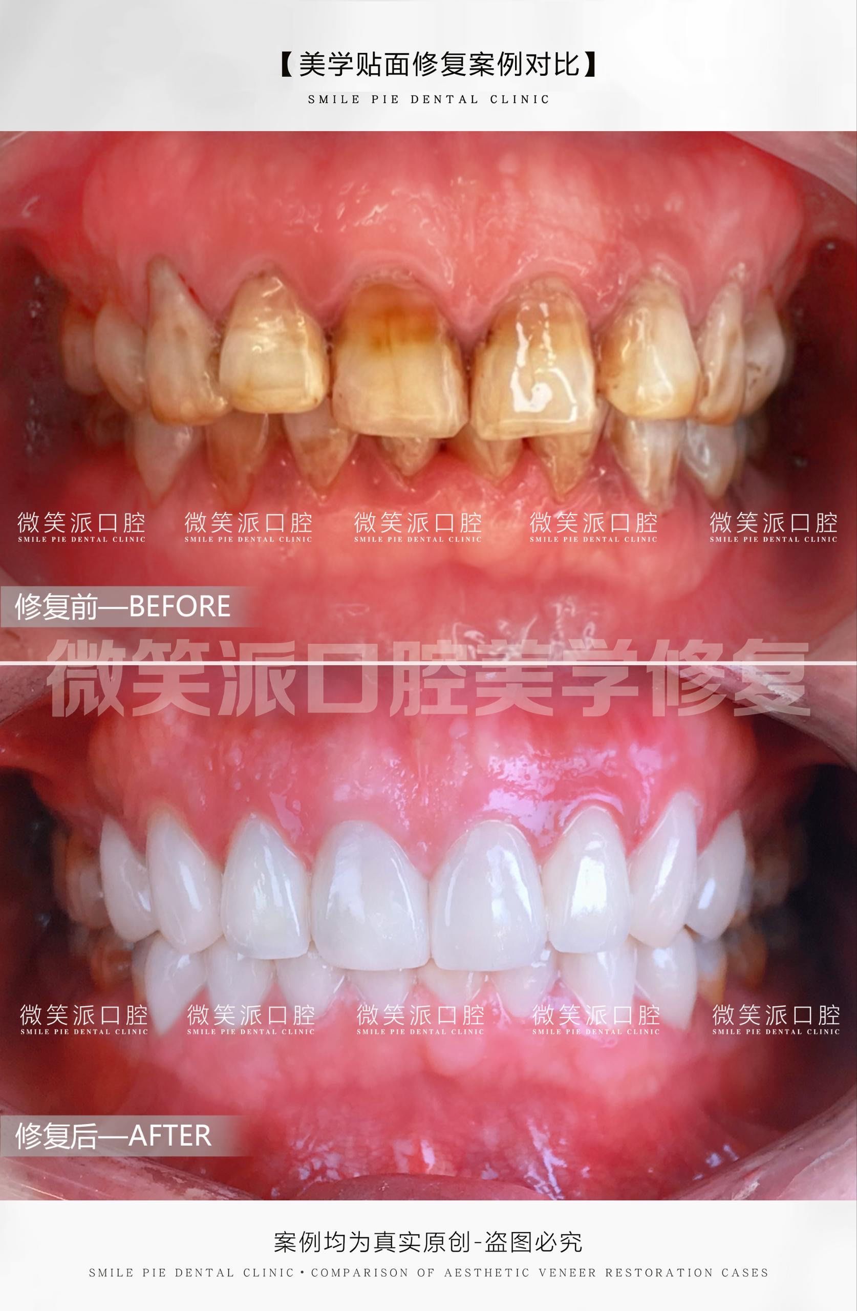 四环素牙是由于在牙齿发育期间服用了四环素类药物导致的牙齿着色或