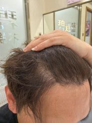 -碧莲盛·不剃发植发