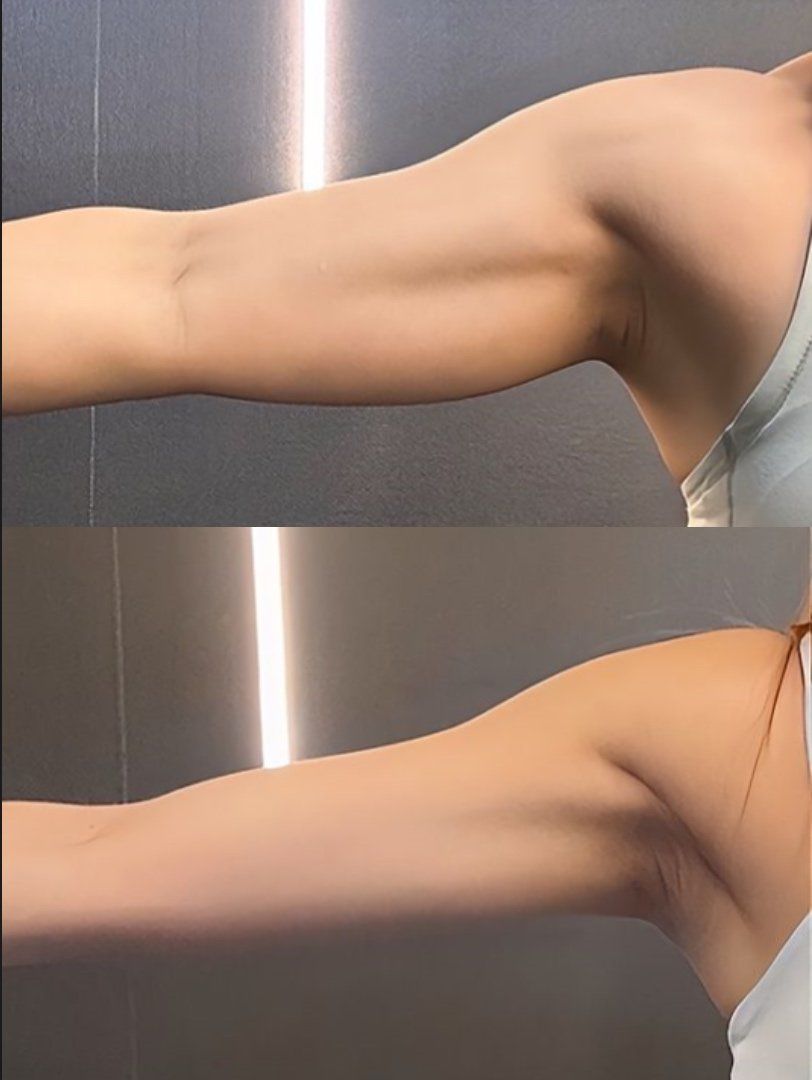 手臂吸脂