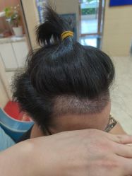 -大麦微针植发丨全国连锁