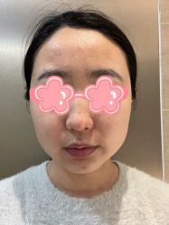 体验后-叶美人医疗美容