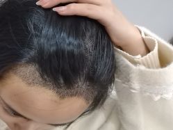 -大麦微针植发全国连锁