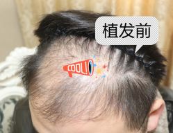 -大麦微针植发全国连锁