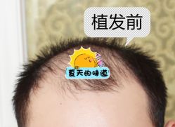 -大麦微针植发全国连锁