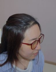 体验后-大麦微针植发全国连锁