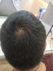 -碧莲盛·不剃发植发