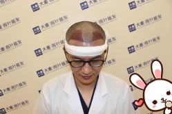 点击看大图 -大麦微针植发丨全国连锁