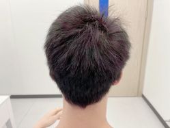-大麦微针植发全国连锁