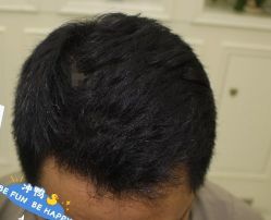 -大麦微针植发丨全国连锁