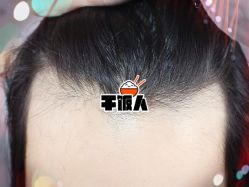 -大麦微针植发全国连锁