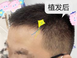 -大麦微针植发全国连锁