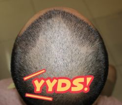 -大麦微针植发丨全国连锁