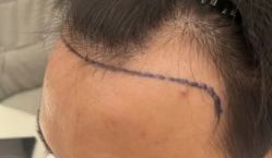 体验前-熙朵美学植发·连锁品牌