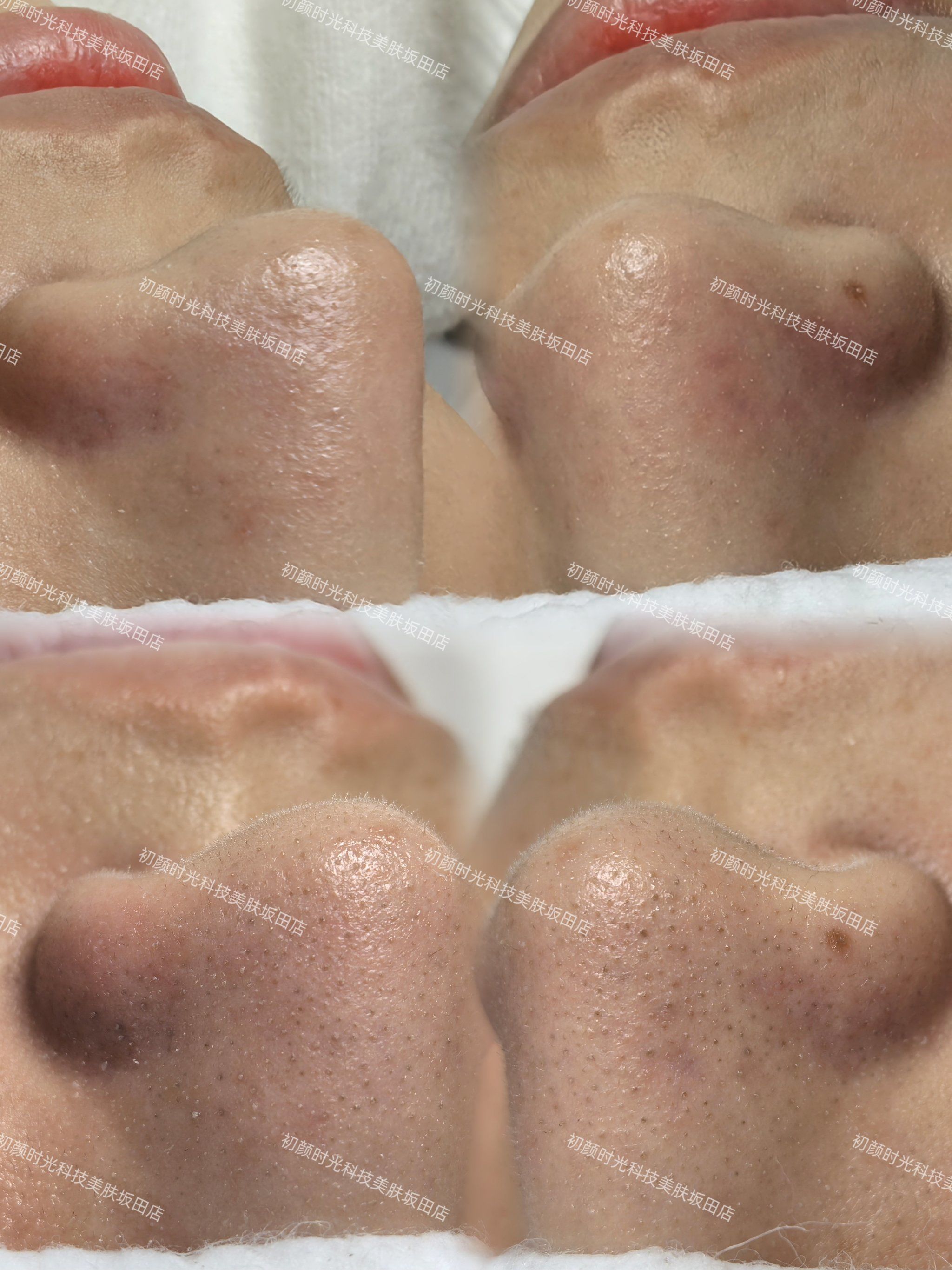 祛黑头前后对比照太爽了