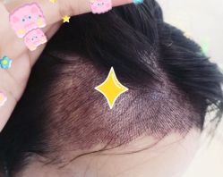 -大麦微针植发全国连锁