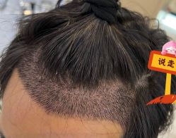 -大麦微针植发全国连锁