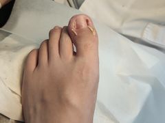 -世龙世家灰指甲鸡眼脚气甲沟炎跖疣护理(通州店)