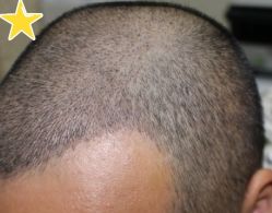 -大麦微针植发丨全国连锁