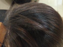 -碧莲盛·不剃发植发