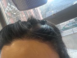 -碧莲盛·不剃发植发