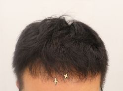 -大麦微针植发全国连锁