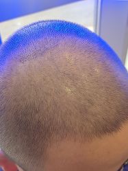 -碧莲盛·不剃发植发