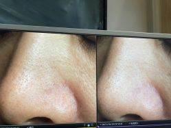 -苑苑vbeauty科技美容SPA