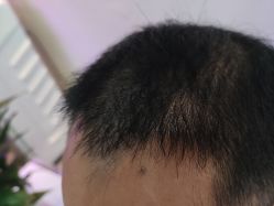 -碧莲盛·不剃发植发