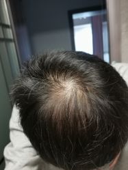 -碧莲盛·不剃发植发