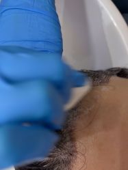 -大麦微针植发全国连锁