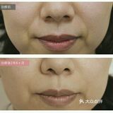 肌肤回春大法，纤维芽细胞培养回输公开！