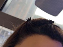 -碧莲盛·不剃发植发