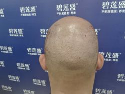 -碧莲盛·不剃发植发