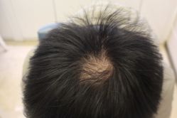 -大麦微针植发丨全国连锁